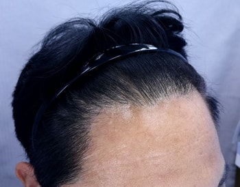 수술전