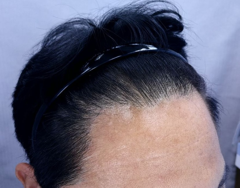 수술전