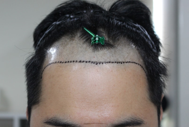 수술전(정면,삭발).jpg