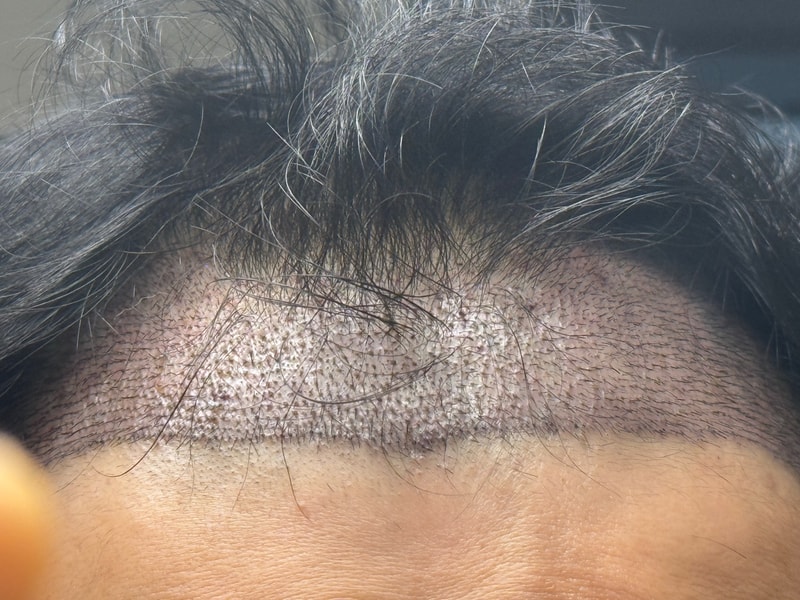 수술후(3일차, 정면).jpg