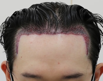 수술후