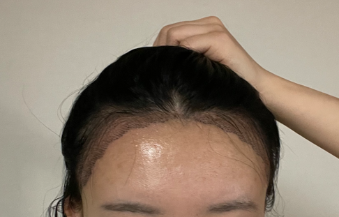 수술후2일차사진 1