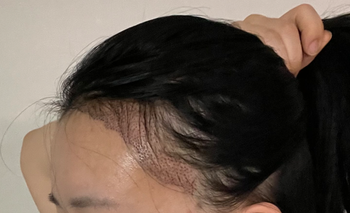수술후2일차사진 3