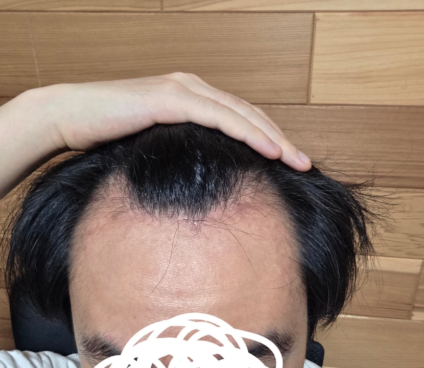 수술전 셀카