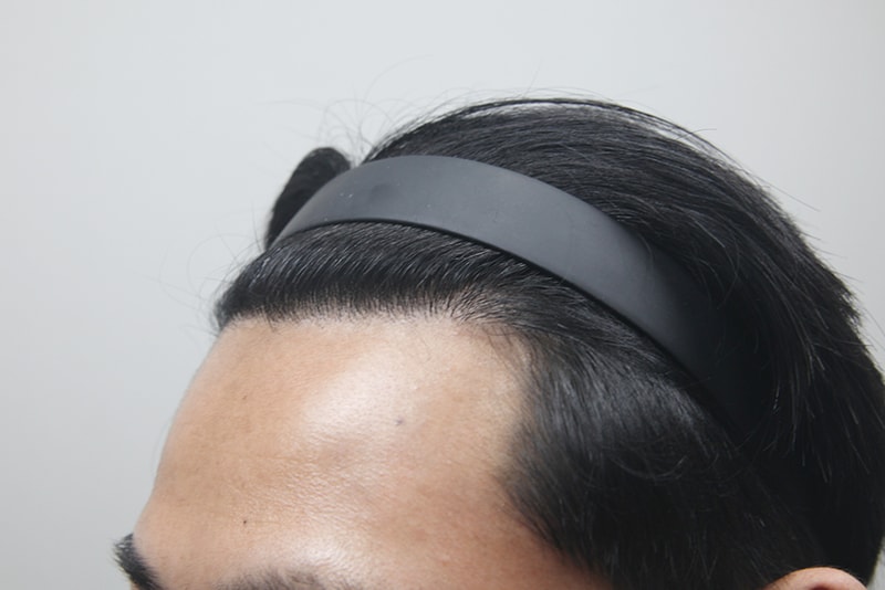 모나라모발이식 (5).jpg