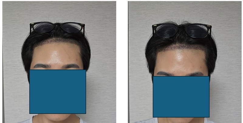 압구정 포헤어 의원 수술 후기