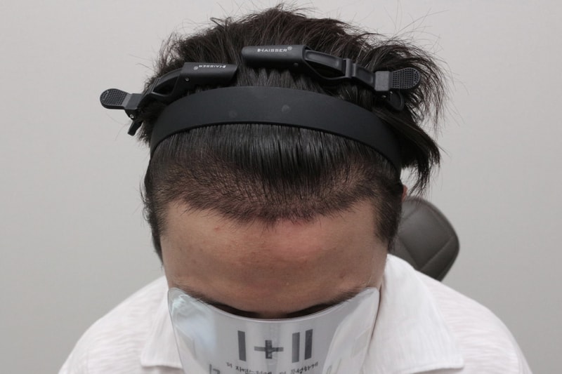 타병원 절개 후 모더함에서 2차 수술 암흑기 21일 경과