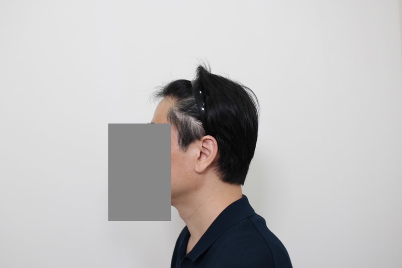 ★신사동 모프로의원★ 헤어라인 M자 이식 7개월 후기
