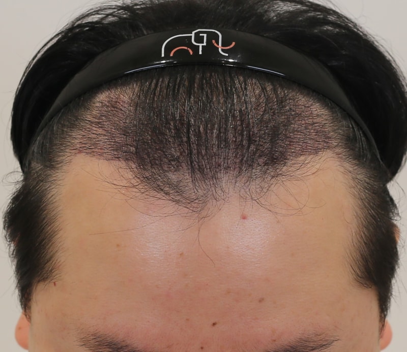 인천 비절개 모발이식 맘모스헤어라인 2주 경과