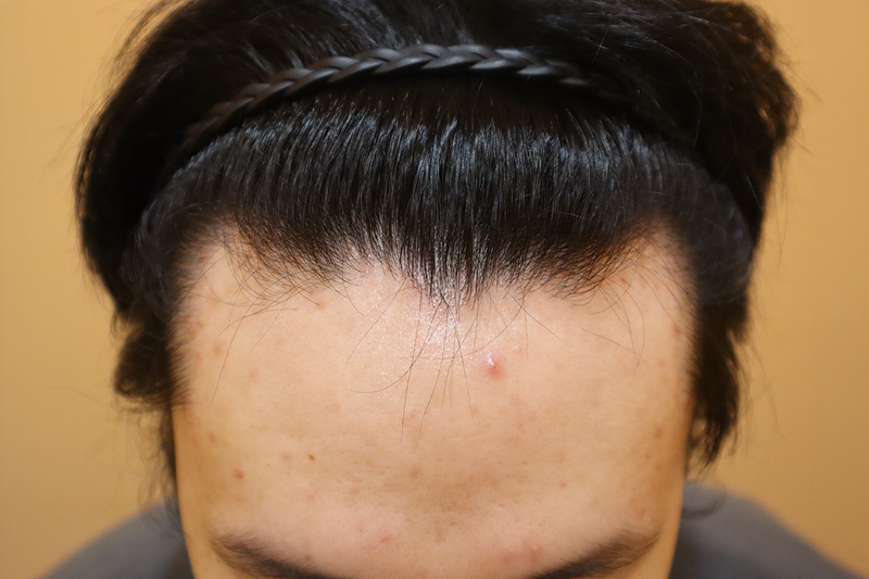 부산탈모성지 헤어로의원 부산점에서 비절개 모발이식 2800모받고 M자탈모 탈출 후기