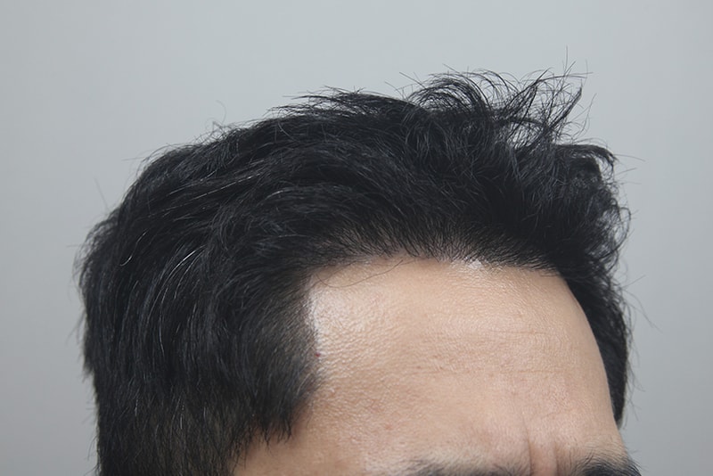 모나라모발이식 (1).jpg