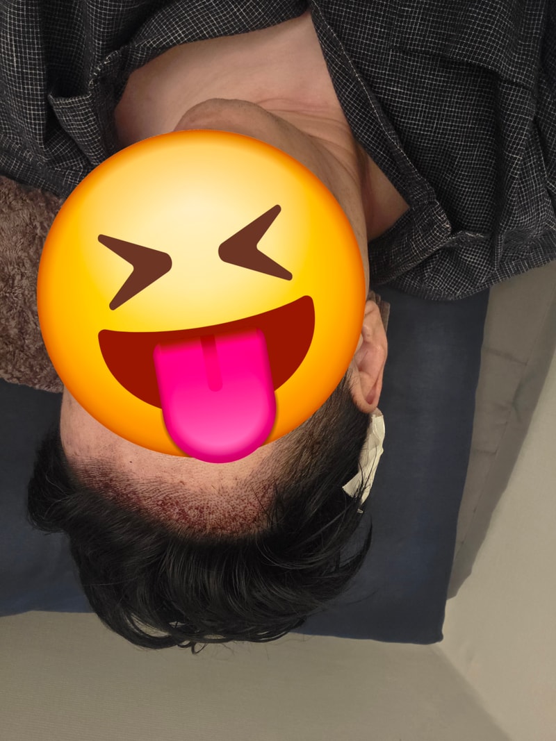 압구정 모우림의원에서 모발이식 해버렸습니다.