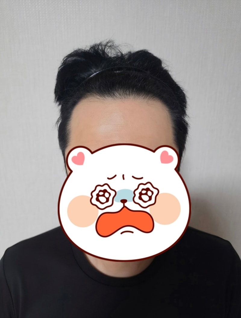 M자 탈모 비절개 모발이식 했습니다