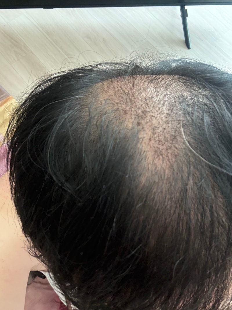 마이모 의원 비절개 700모낭 모발이식 한 달 차 후기입니다~~!!