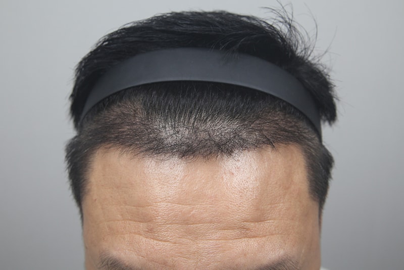 모나라피부과_모발이식-(4).jpg