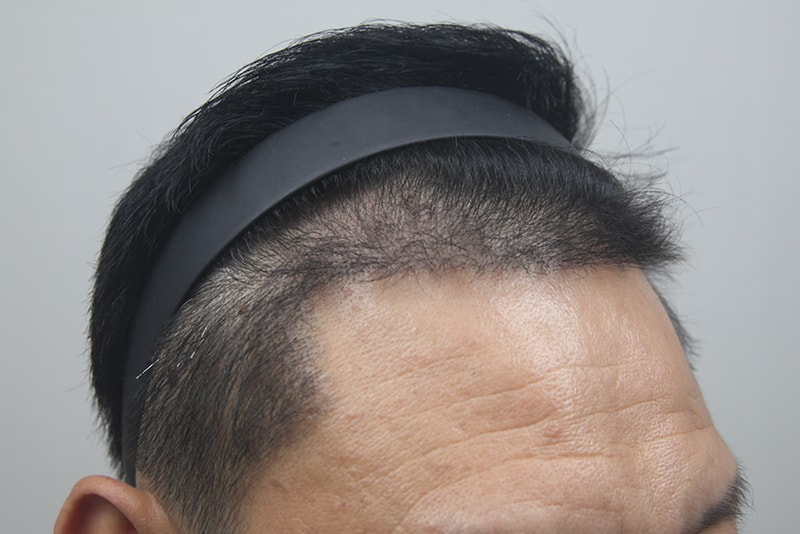 모나라피부과_모발이식-(6).jpg