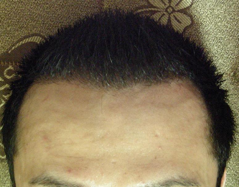 캐나다 dr. 라할 6개월 후기 -앞,뒤- (25일이면 7개월)