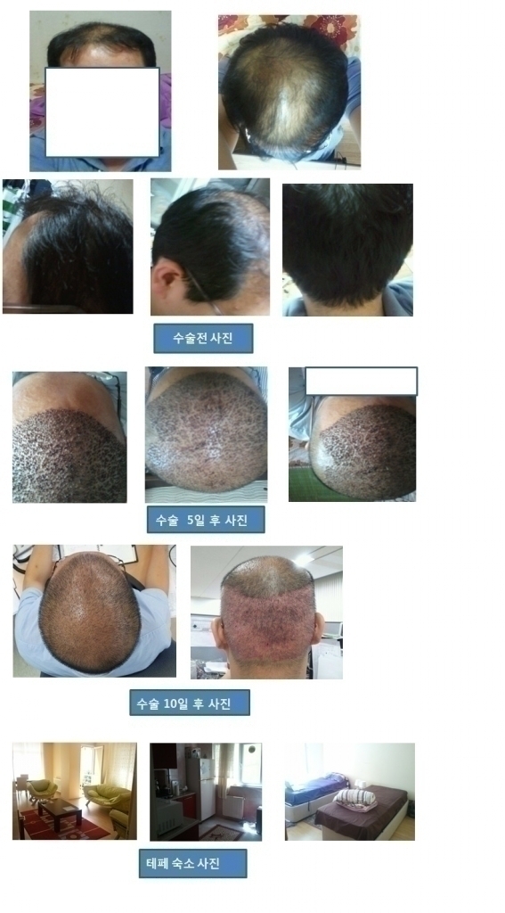 터키 테페(TEPE)센터 4600모낭 수술 후기
