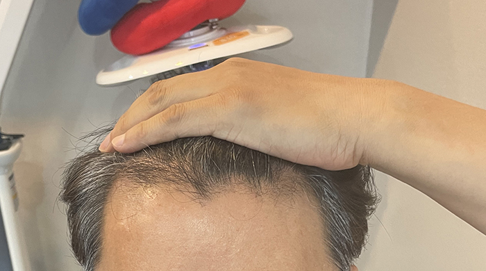수술 1개월차 prp주사 맞은 후 셀카