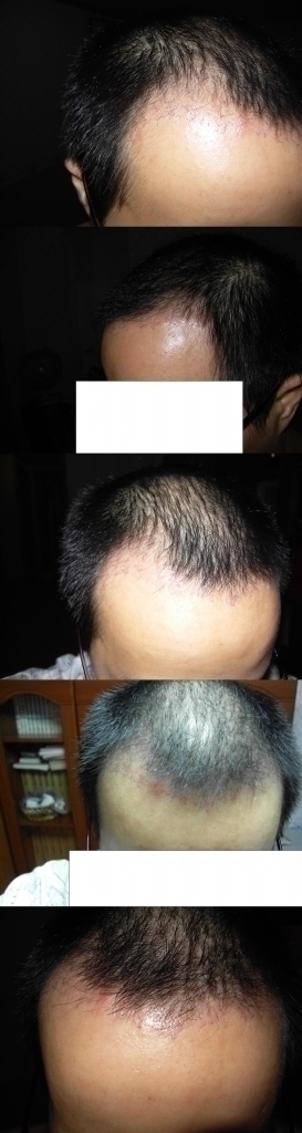 모션 40일째.. m자 후기.