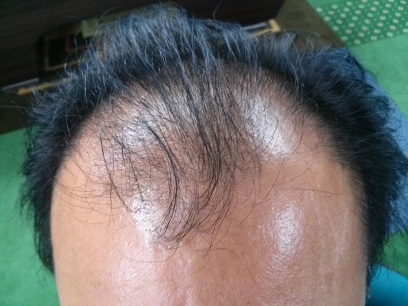 모제림에서 이식받기로 결정을 했는데 마음이 좀 후련합니다.
