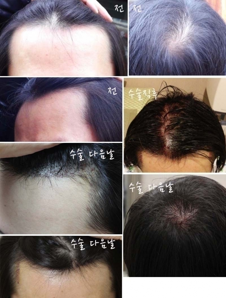 JP성형외과 3000모 M자 + 정수리 두곳 절개법 수술했습니다. 