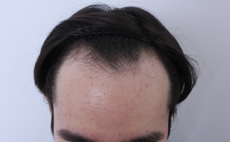 강남 ㅁㅅㅇ m자 수술전~3개월 경과사진입니다. 평가해주세요.