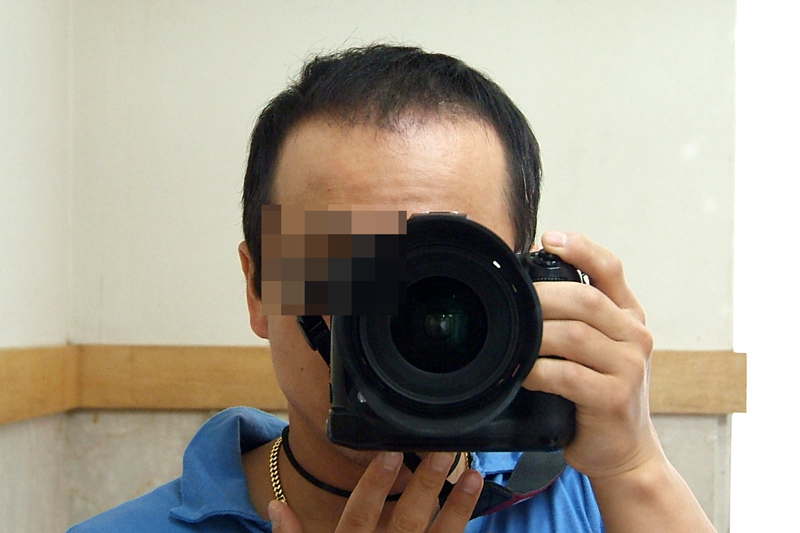 05수술후4개월.jpg