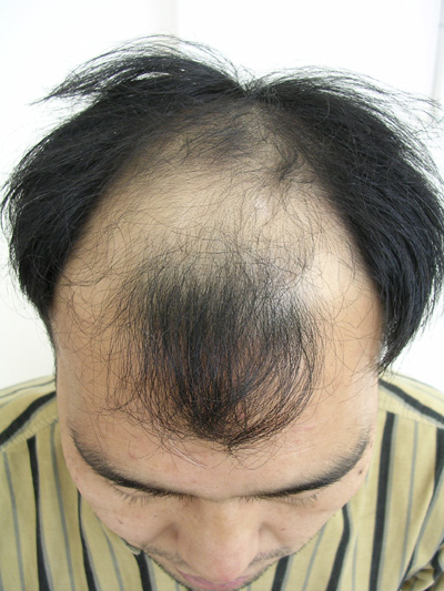 시술전11.jpg
