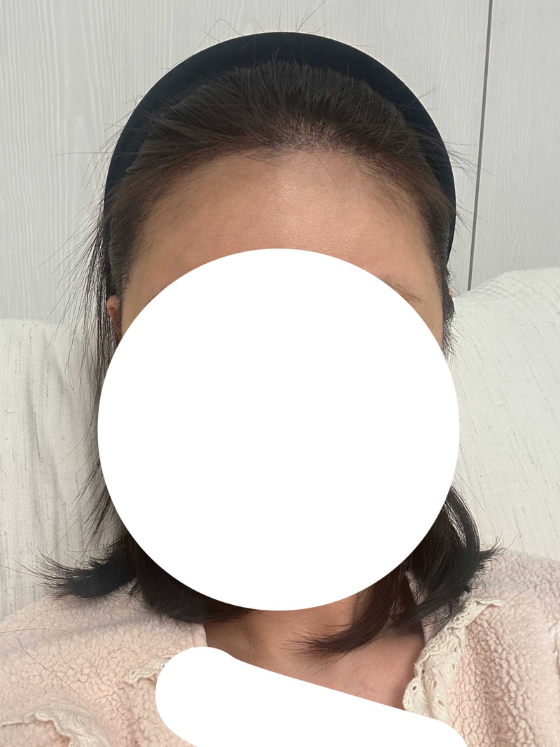 수술후2개월4.jpg