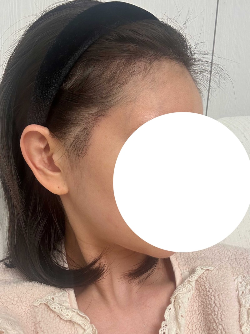 수술후2개월2.jpg