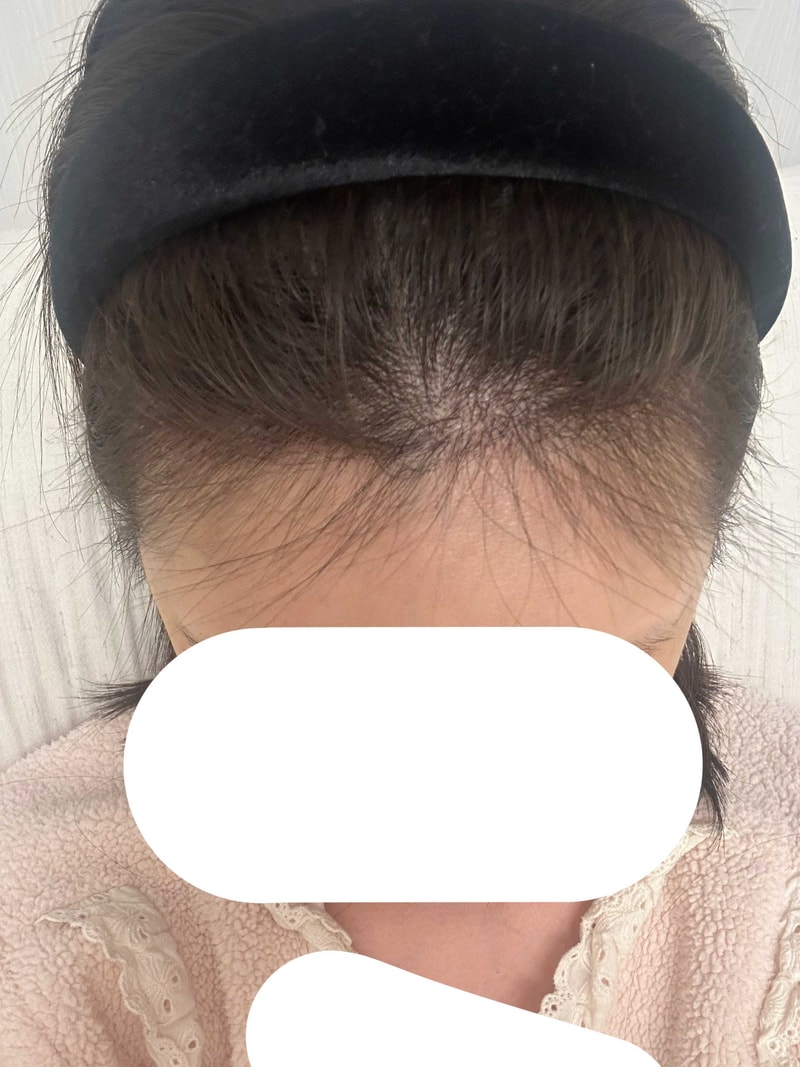 수술후2개월1.jpg