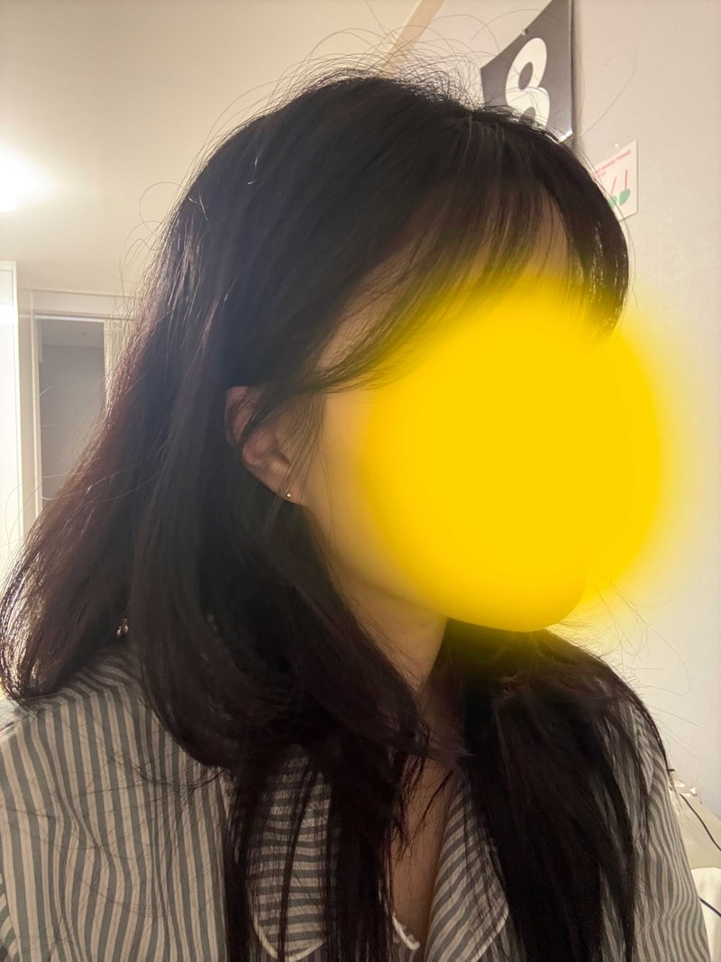 헤어라인후7개월3.jpg