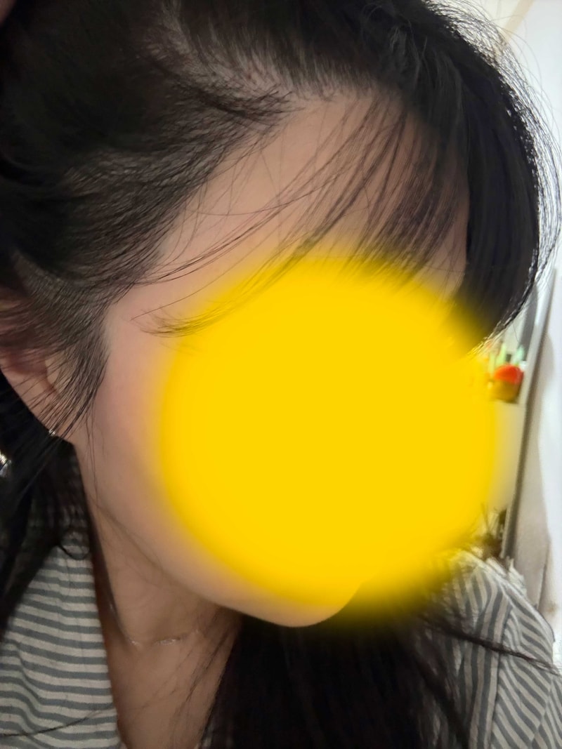 헤어라인후7개월2.jpg
