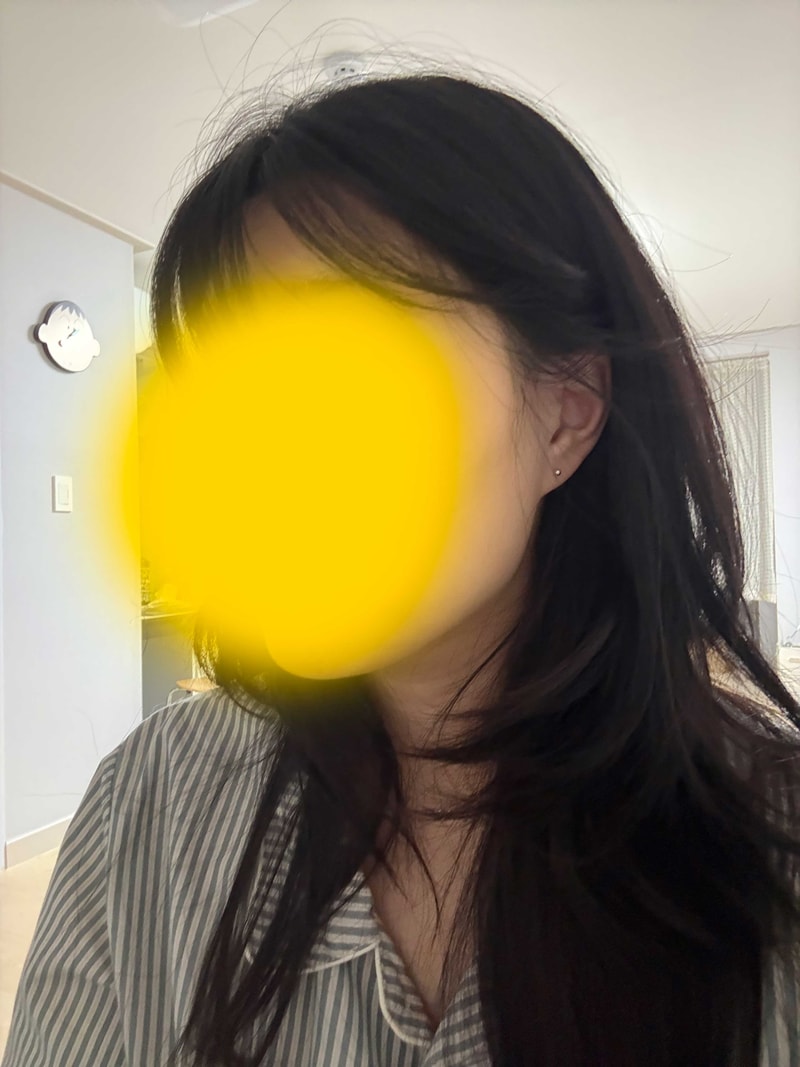헤어라인후7개월1.jpg