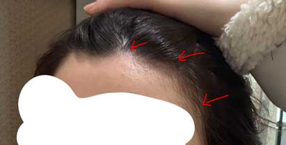 수술전에 비어보이는 부분.jpg