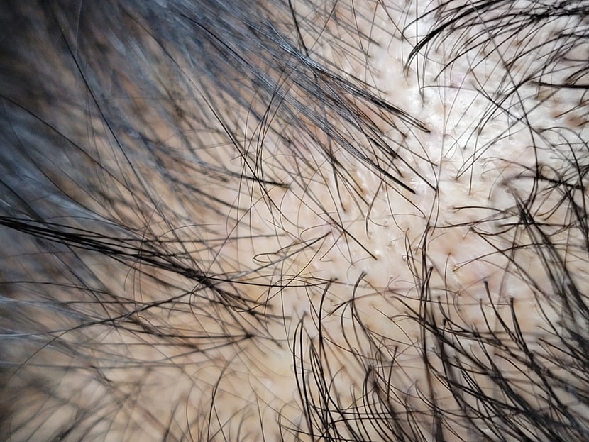 메디헤어 케어 직후 두피 사진 (3배줌) - 발갛게 된 부븐이 있네요