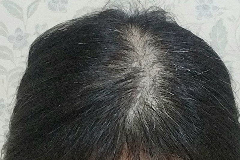 TS어성초카밍샴푸 2주차후기입니다.