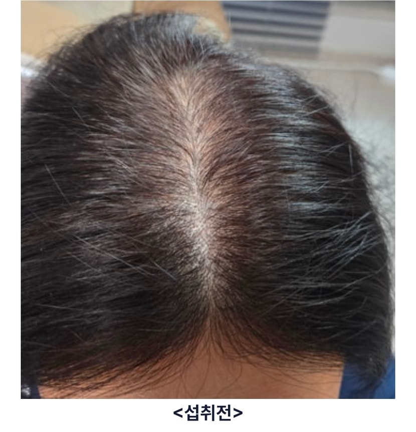 섭취전