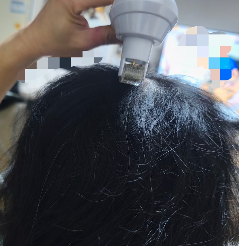 시술?사진 민망하네요ㅎㅎ