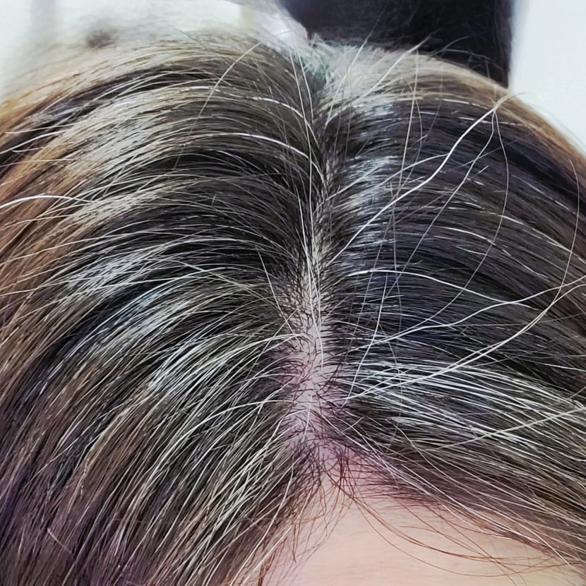 3주차 지나며 안정화된 두피