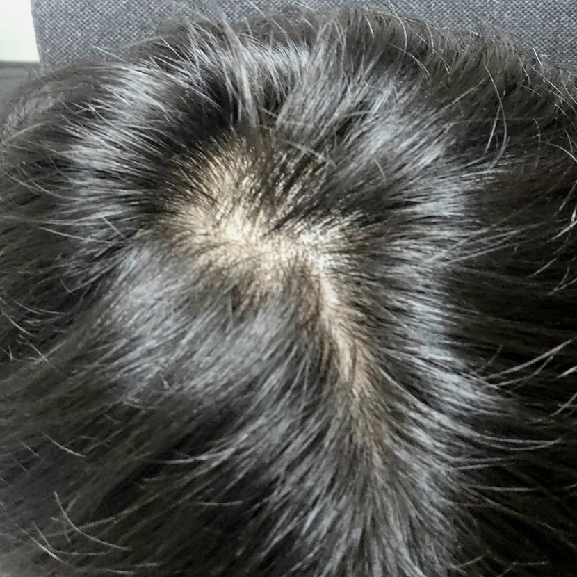 예전에는 이렇지 않았는데 갈 수록 하얘지는 두피