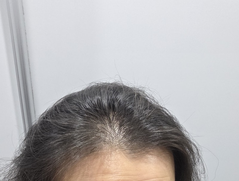 앞머리 탈모로 고민하다 정착한 탈모샴푸 후기
