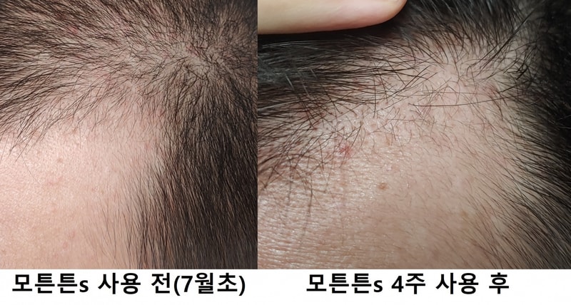 전두부M자 왼쪽3.jpg
