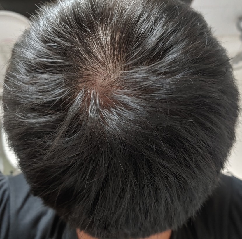 두피 뒤쪽 정수리, 뒤통수