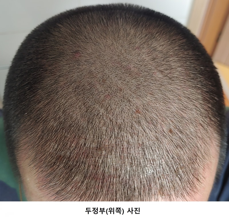 사용 전 두정부 사진.png