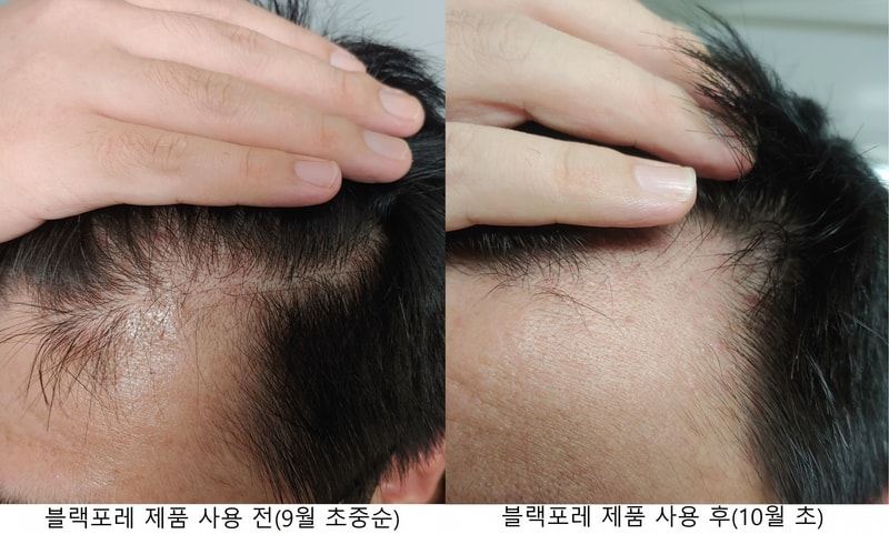 M자 왼쪽 비교jpg.jpg