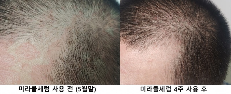 전두부 비교사진22.jpg