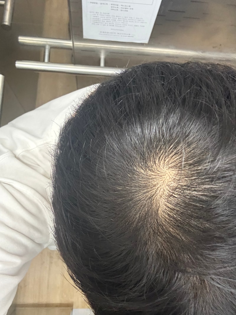 Vinic Regenoxil高级脱发洗发水 2周后记
