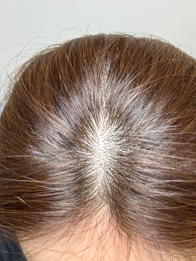 Dr. Novid's first week review of seborrheic scalp shampoo